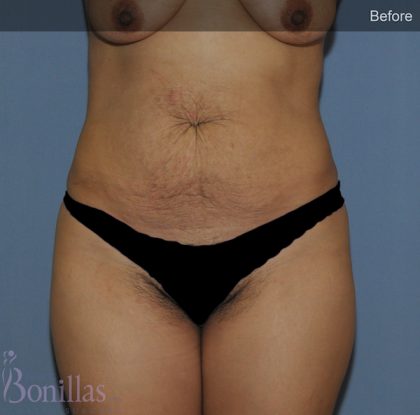 Tummy Tuck Before & After Patient #11446