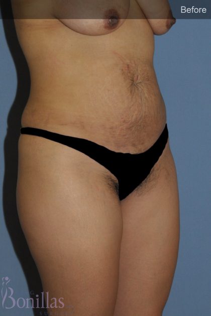 Tummy Tuck Before & After Patient #11446