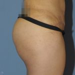 Butt Augmentation Before & After Patient #11510