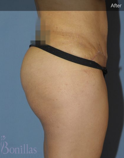 Butt Augmentation Before & After Patient #11510