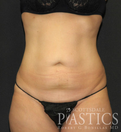 Tummy Tuck Before & After Patient #11893