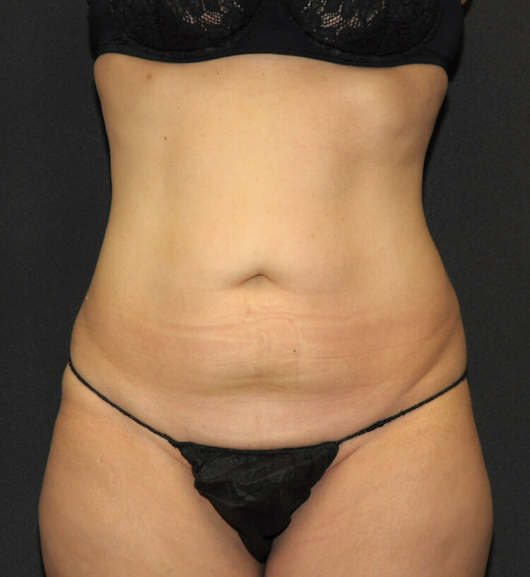Tummy Tuck Before & After Patient #11893