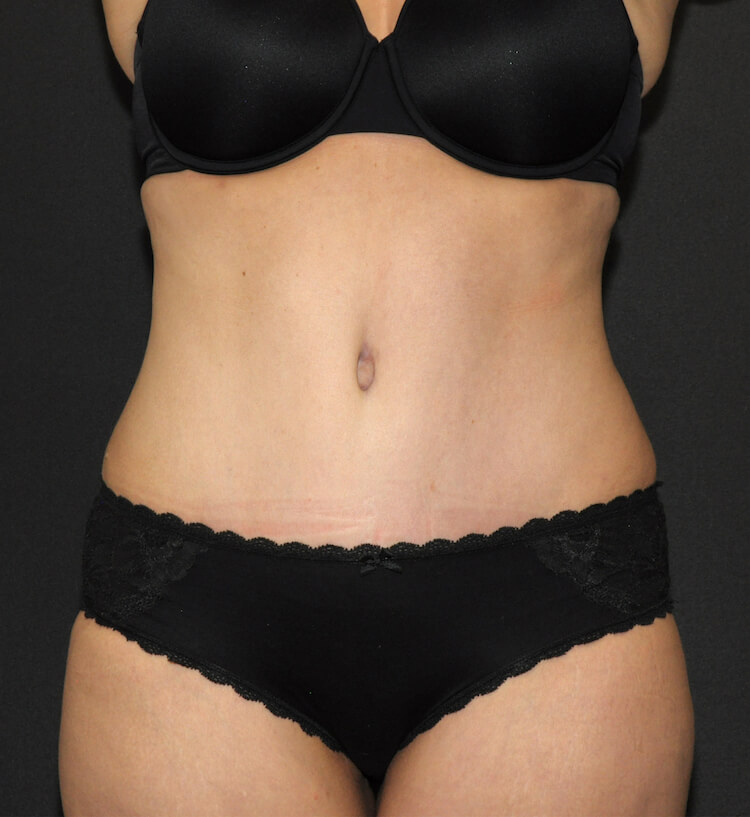 Tummy Tuck Before & After Patient #11893