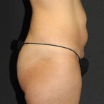 Tummy Tuck Before & After Patient #11893