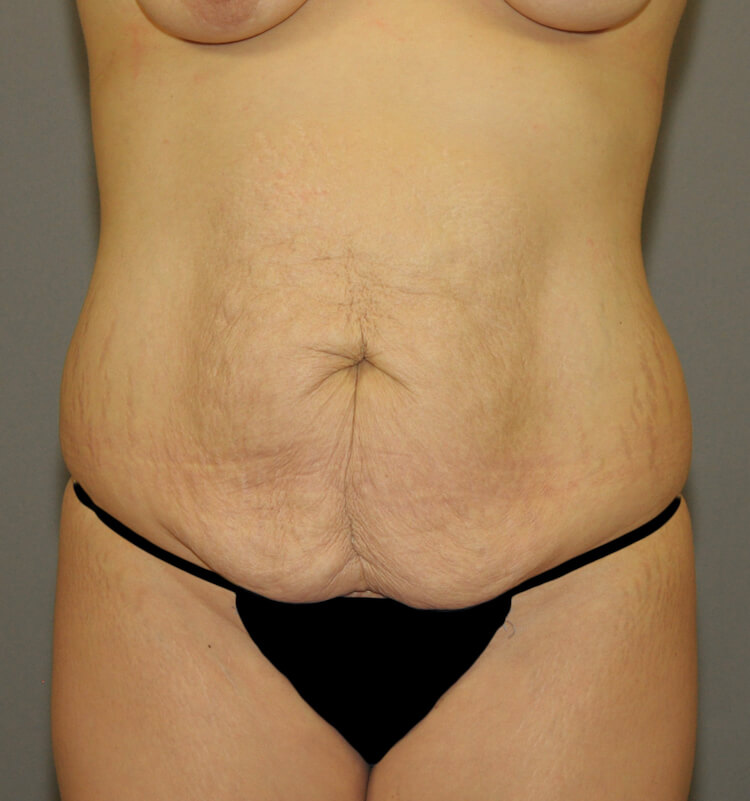 Tummy Tuck Before & After Patient #11900