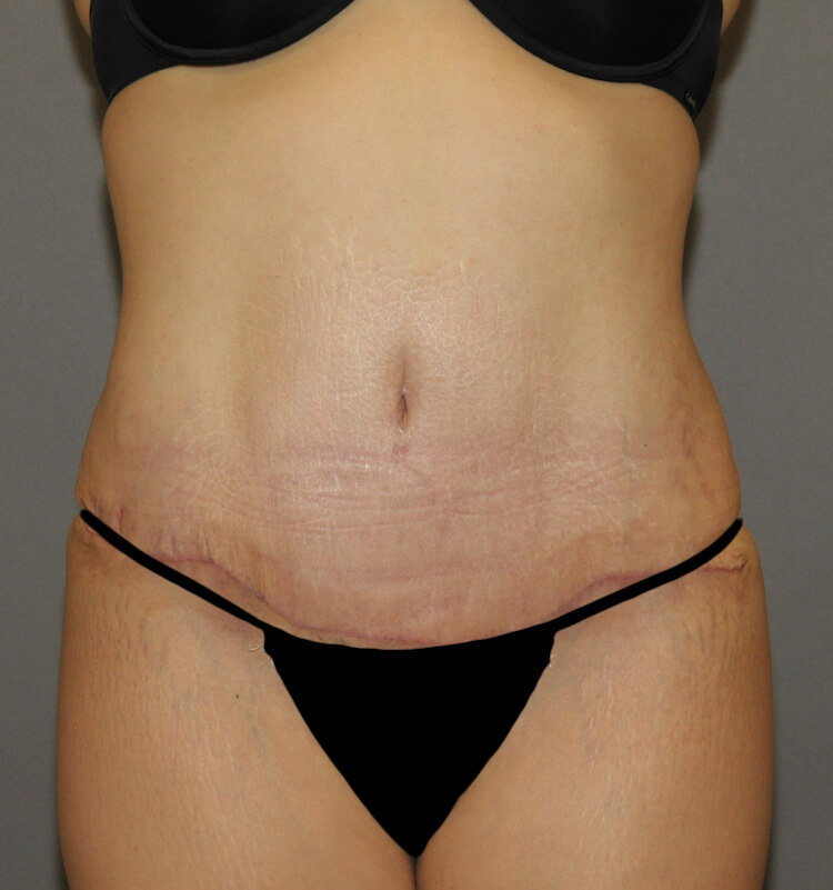 Tummy Tuck Before & After Patient #11900