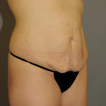Tummy Tuck Before & After Patient #11900
