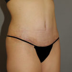 Tummy Tuck Before & After Patient #11900