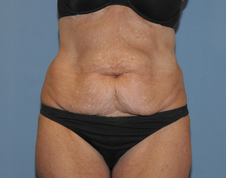 Tummy Tuck Before & After Patient #11907