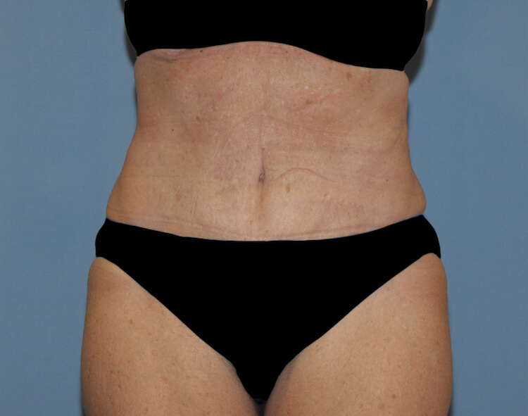 Tummy Tuck Before & After Patient #11907