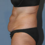 Tummy Tuck Before & After Patient #11907