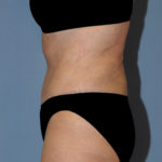 Tummy Tuck Before & After Patient #11907