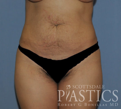 Tummy Tuck Before & After Patient #11914