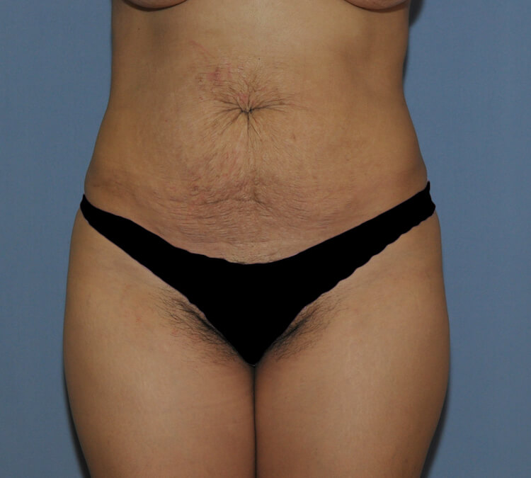 Tummy Tuck Before & After Patient #11914