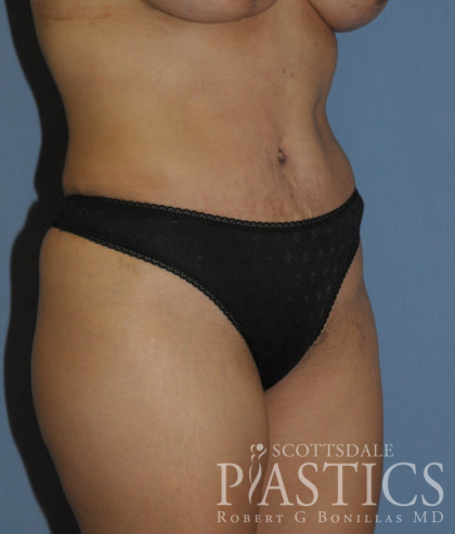 Tummy Tuck Before & After Patient #11914