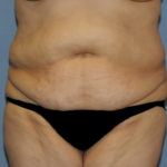 Tummy Tuck Before & After Patient #11922