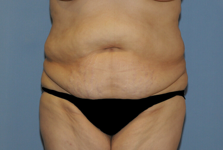 Tummy Tuck Before & After Patient #11922