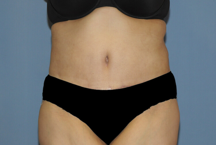 Tummy Tuck Before & After Patient #11922
