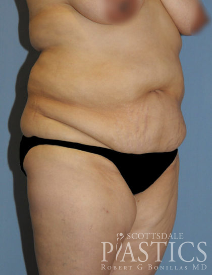 Tummy Tuck Before & After Patient #11922