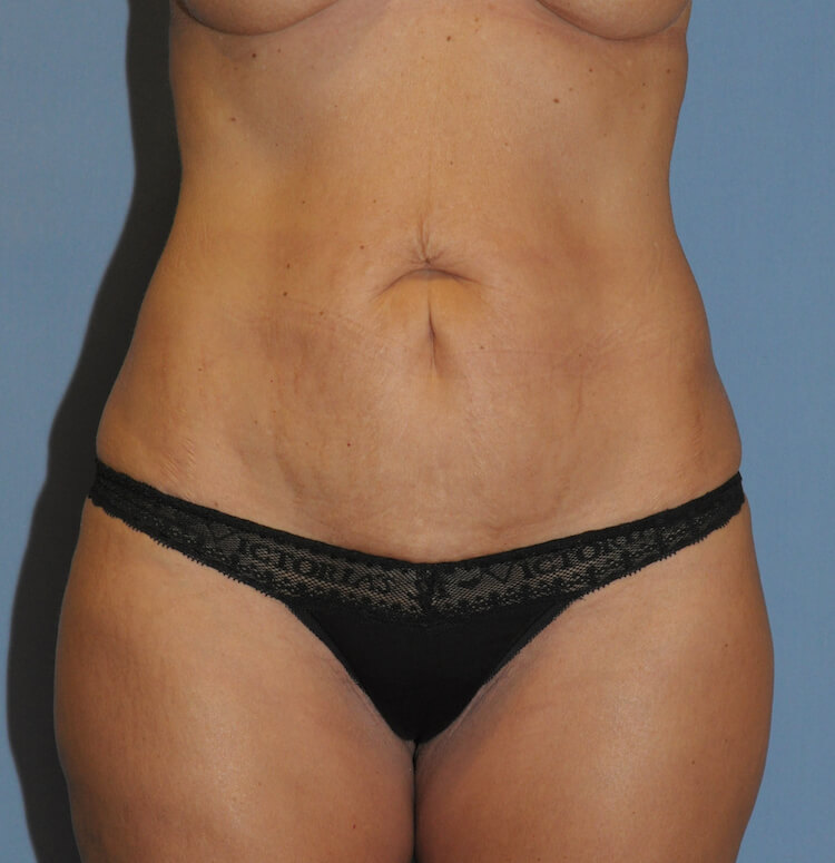 Tummy Tuck Before & After Patient #11929