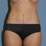 Tummy Tuck Before & After Patient #11929