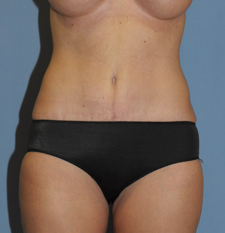 Tummy Tuck Before & After Patient #11929