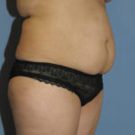 Tummy Tuck Before & After Patient #11936
