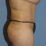 Tummy Tuck Before & After Patient #11936
