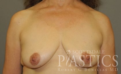 Breast Lift Before & After Patient #11961