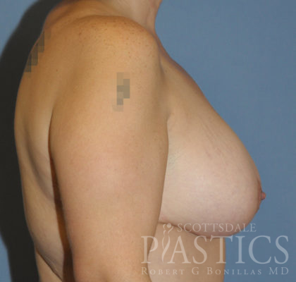 Breast Lift Before & After Patient #11968