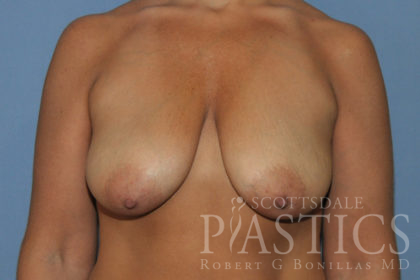 Breast Lift Before & After Patient #11975