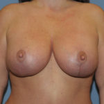 Breast Lift Before & After Patient #11982