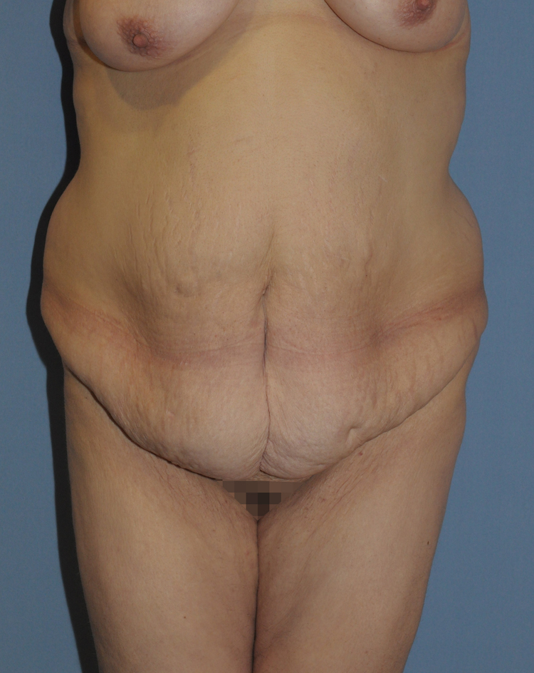 Body Lift Before & After Patient #12014
