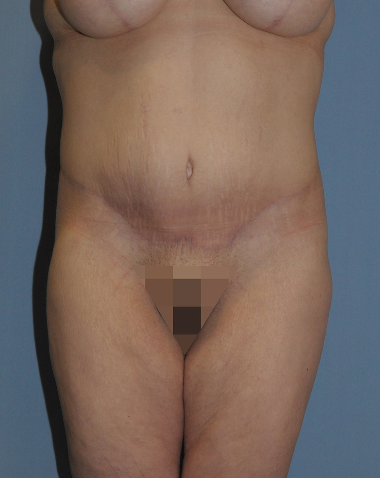 Body Lift Before & After Patient #12014