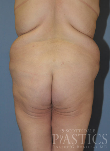 Body Lift Before & After Patient #12014