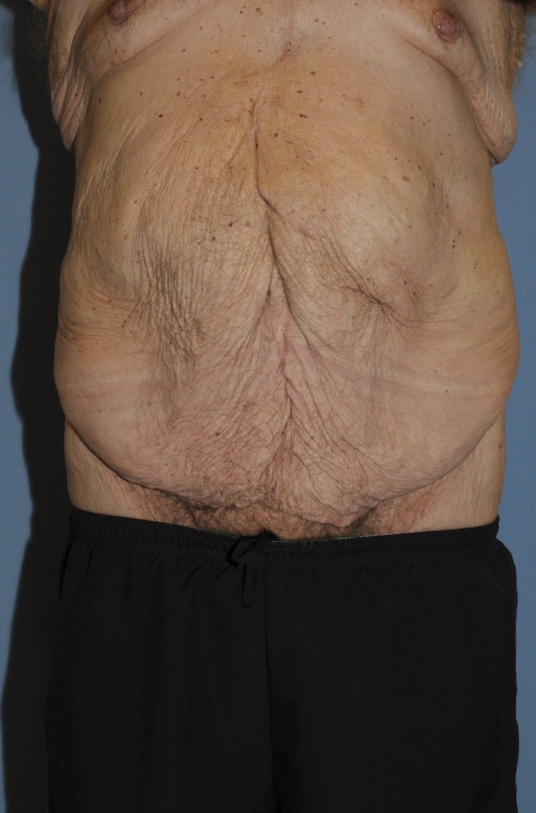 Body Lift Before & After Patient #12031