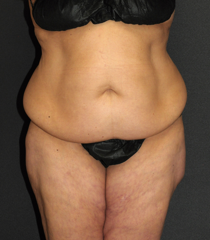Body Lift Before & After Patient #12048
