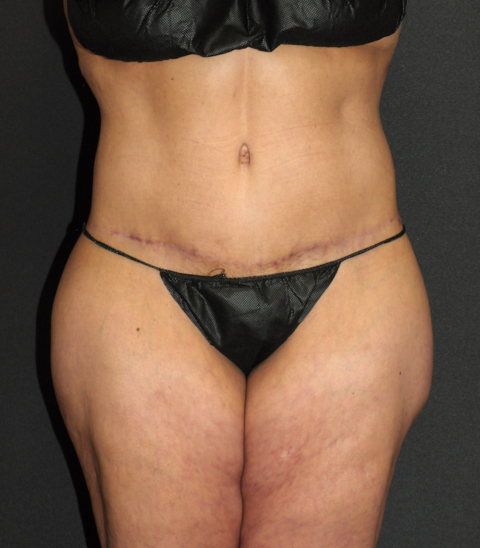 Body Lift Before & After Patient #12048