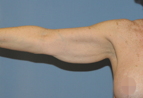 Arm Lift Before & After Patient #12065