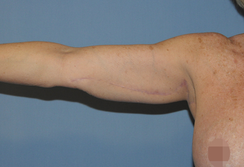 Arm Lift Before & After Patient #12065