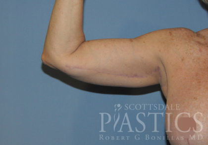 Arm Lift Before & After Patient #12065