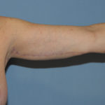 Arm Lift Before & After Patient #12065
