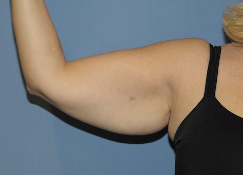 Arm Lift Before & After Patient #12082