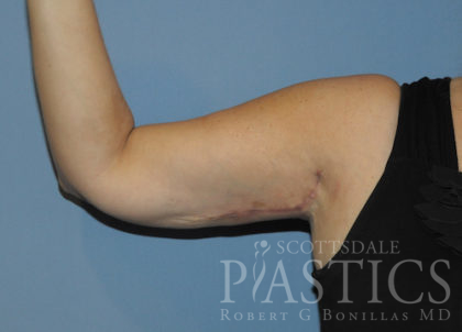 Arm Lift Before & After Patient #12082