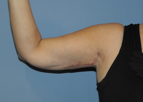 Arm Lift Before & After Patient #12082