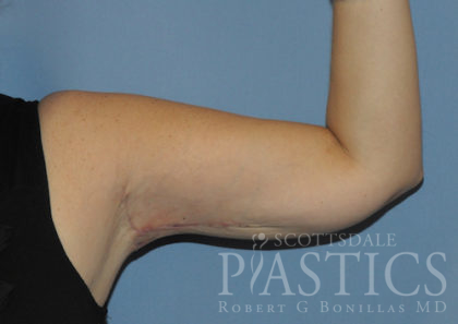 Arm Lift Before & After Patient #12082