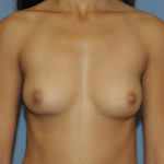 Breast Augmentation Before & After Patient #12098