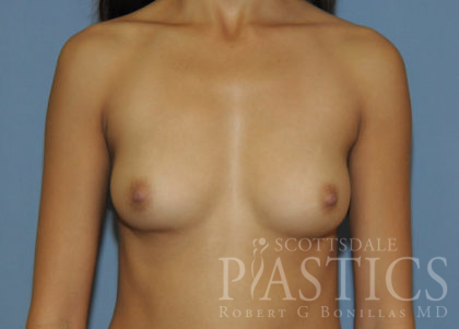 Breast Augmentation Before & After Patient #12098