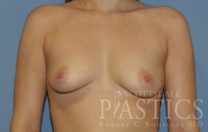 Breast Augmentation Before & After Patient #12105