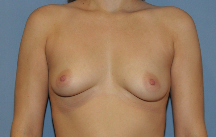 Breast Augmentation Before & After Patient #12105